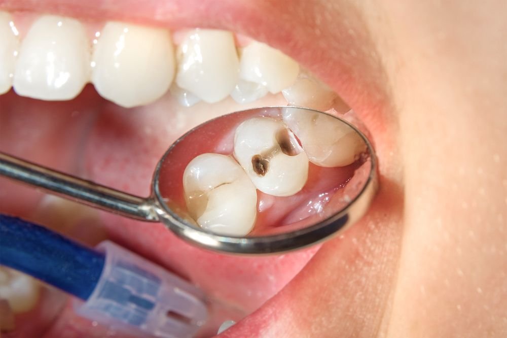 Gata cu cariile: cercetătorii au creat gelul care repară smalțul dentar în doar o săptămână